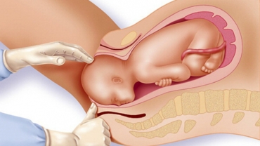 Mechanism of Normal Labour and Vaginal Delivery
