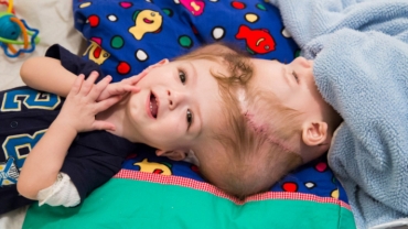 New Life: Rare Surgery to Separate Conjoined Twins