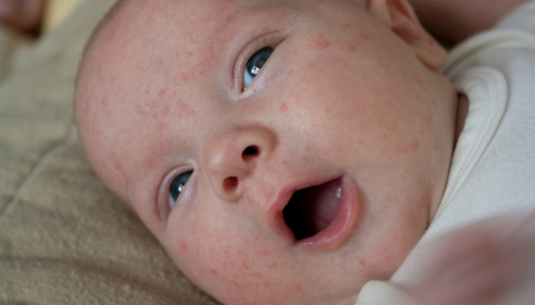 How to Handle Baby Acne?