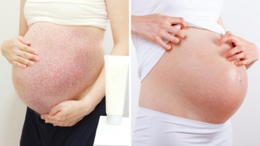 6 Annoying Pregnancy Skin Issues (And How to Deal)