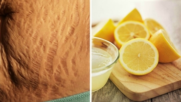 9 Natural Remedies For Removing Pregnancy Stretch Marks