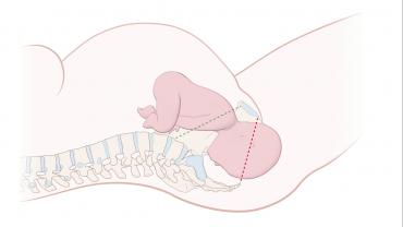 Childbirth: Occiput Anterior Position