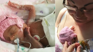 Miracle Baby Born at 24-Weeks with Feet the Size of Pennies