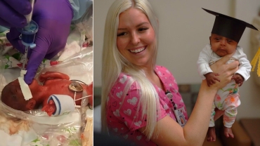 World's Tiniest Surviving Baby Was Size Of Apple At Birth