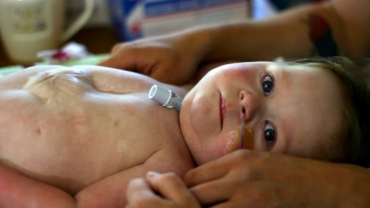 Baby Born With Heart Outside Her Chest