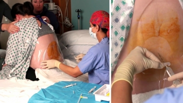 Birth Guide: Epidural Anaesthesia for Pregnant Women