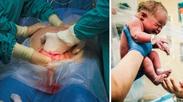 Birth Knowledge: Cesarean Surgery