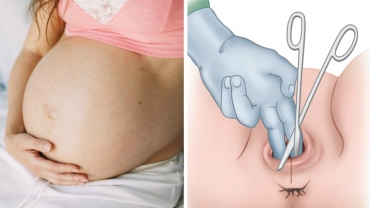 Birth Knowledge: Episiotomy During Childbirth