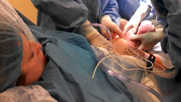 C-Section Birth for a Breech Baby