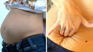 Collapsed Stomach Muscles After Childbirth