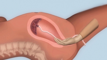 Compression and Tamponade for Postpartum Haemorrhage