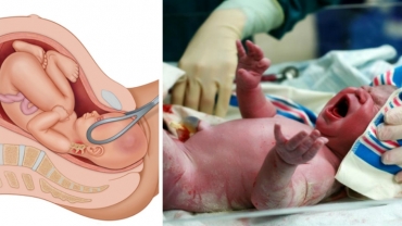 Different Types of Childbirth You Should Know