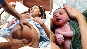 Doctor Turns Breech Baby Still in Mother's Belly