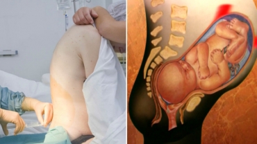 Epidural Pain Relief for Labor