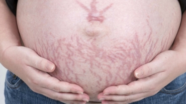 How Can I Get Rid of Pregnancy Stretch Marks?