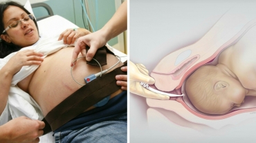 How to Induce Labor Medically?