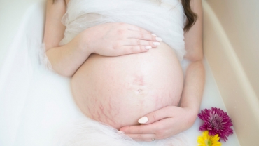 How to Minimize Pregnancy Stretch Marks: 7 Tips