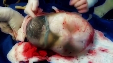 Incredible Footage of Baby Born Still Inside Amniotic Sac