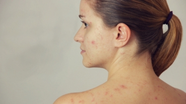 Pregnancy Skin Problems: How to Treat Acne During Pregnancy?