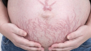 Pregnancy Stretch Marks: Prevention and Treatment