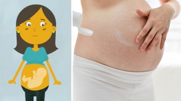 Stretch Marks During Pregnancy