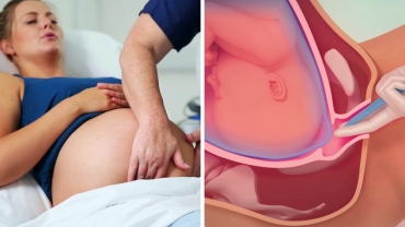 Techniques and Medications for Induction of Labour