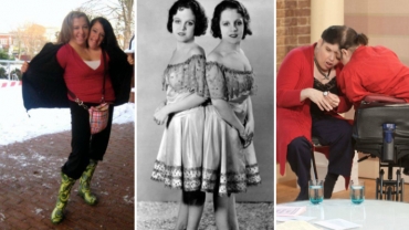 The Most Amazing Conjoined Twins