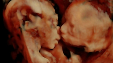Ultrasound Shows Twins Kissing in Mother's Womb