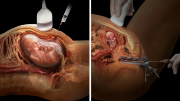 What Happens During a Chorionic Villus Sampling (CVS) Test?