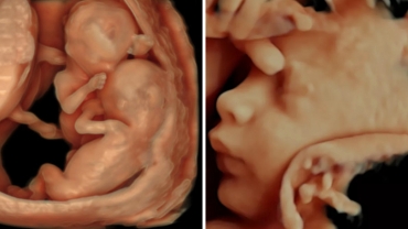 What is 4D Ultrasound: What is the Difference Between 3D and 4D?