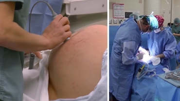 What to Expect Before, During and After Your Caesarean Section