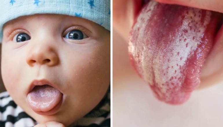 Oral Thrush in Babies