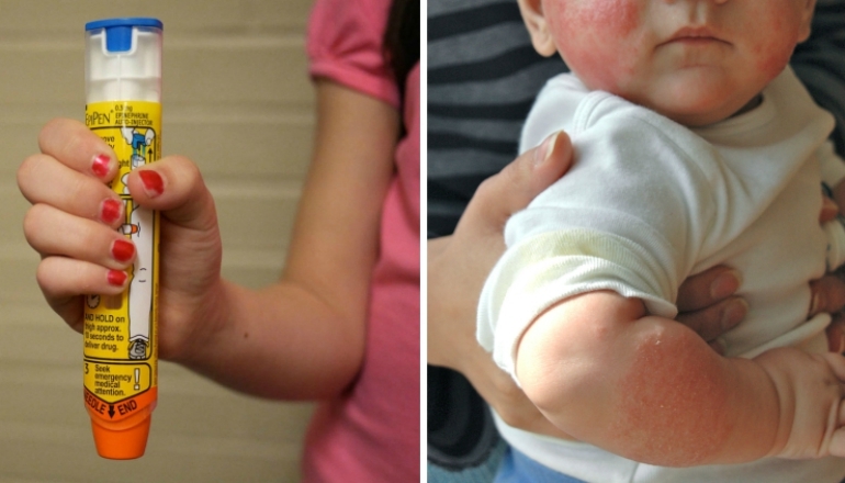 What to Do if Your Baby Has Had a Severe Allergic Reaction?