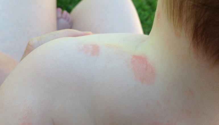 What You Need to Know About Ringworm in Babies