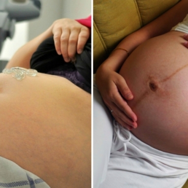 4 Pregnancy-Related Vaginal Infections: What You Need to Know