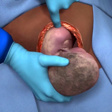 Cesarean Section Delivery Simulator