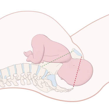 Childbirth: Occiput Anterior Position