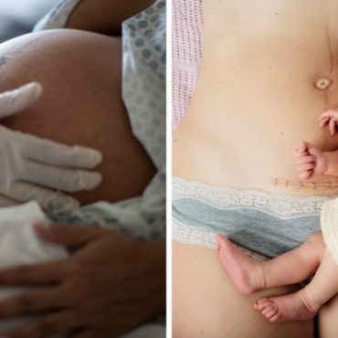 Everything You Need to Know About Having a C-Section: Pros and Cons