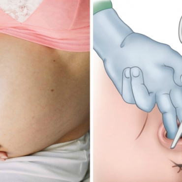 Birth Knowledge: Episiotomy During Childbirth