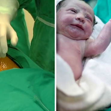 Cesarean Section: What to Expect?