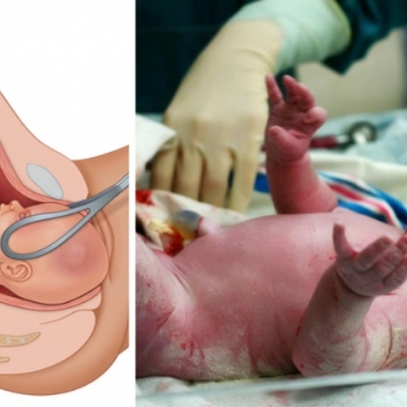 Different Types of Childbirth You Should Know