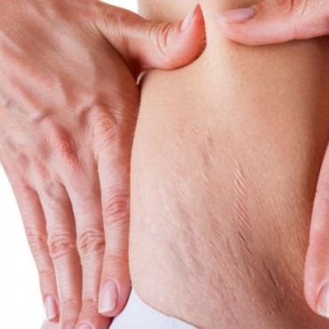 DIY Belly Cream to Prevent Pregnancy Stretch Marks