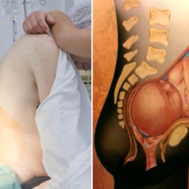 Epidural Pain Relief for Labor