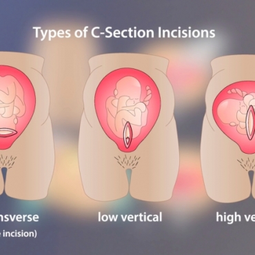 Everything You Need to Know About Cesarean Section