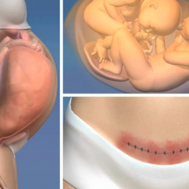 Everything You Need to Know About the Caesarean Section