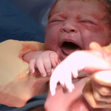 Giving Birth by Cesarean Section: All You Need to Know