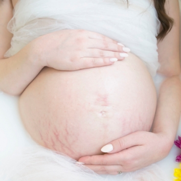 How to Minimize Pregnancy Stretch Marks: 7 Tips