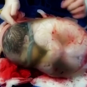 Incredible Footage of Baby Born Still Inside Amniotic Sac