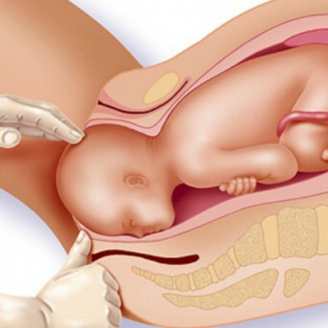 Mechanism of Normal Labour and Vaginal Delivery