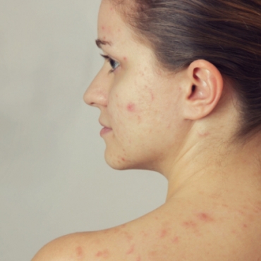 Pregnancy Skin Problems: How to Treat Acne During Pregnancy?